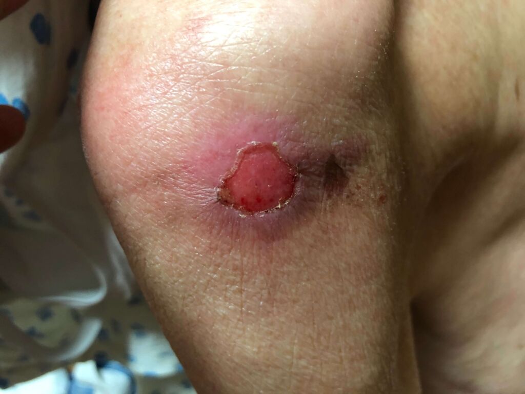 pressure ulcer